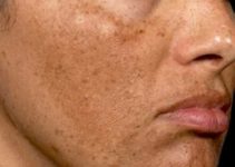 ¿Cómo Quitar las Manchas del SOL en la Cara?