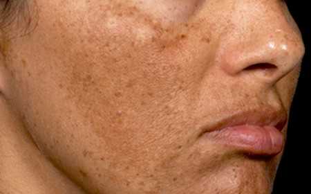 Ve cómo borrar manchas del sol en la cara