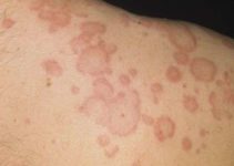 ¿Cómo Son las Manchas en la Piel por ESTRÉS?