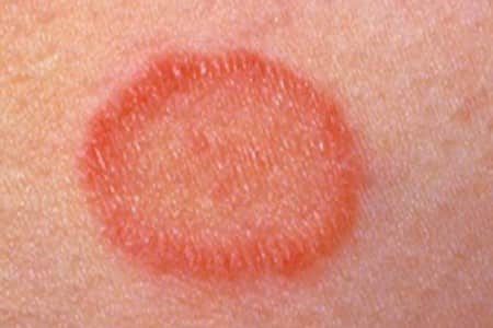 Qué es la pitiriasis rosada